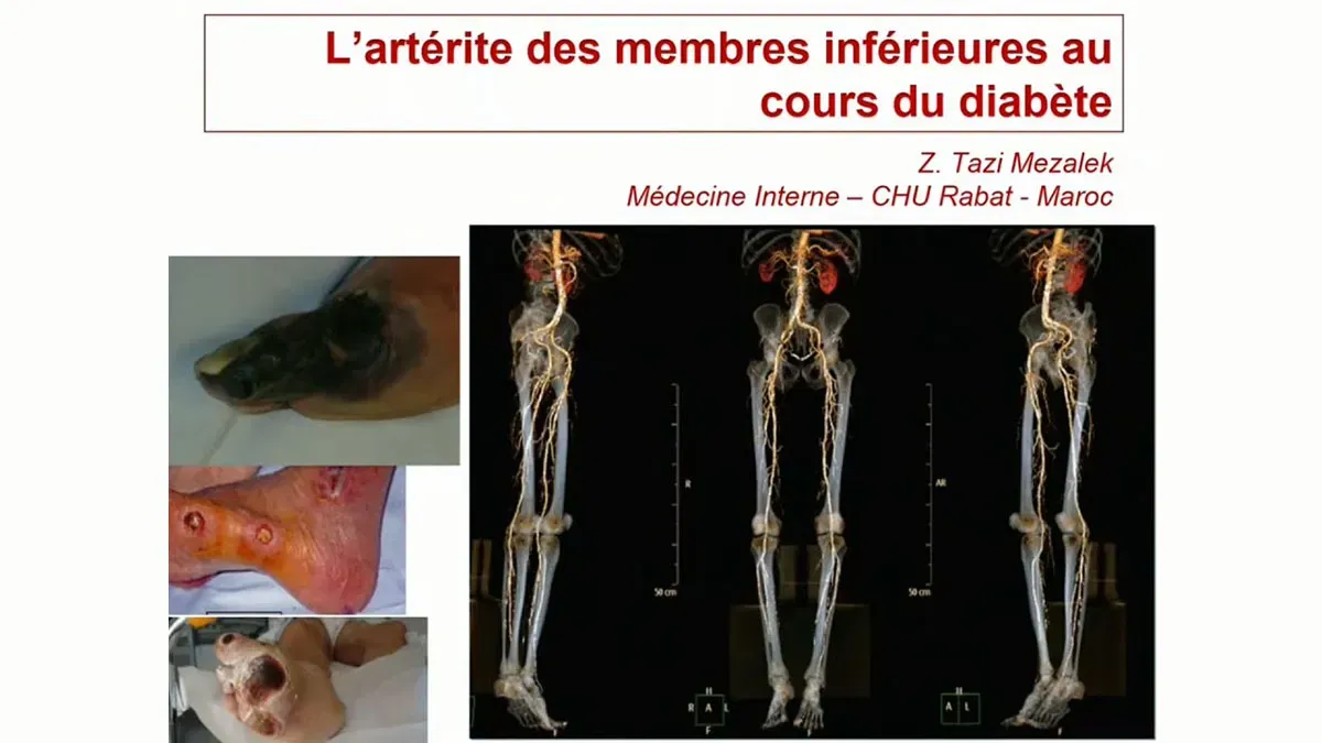 Artérite des membres inférieurs et diabète